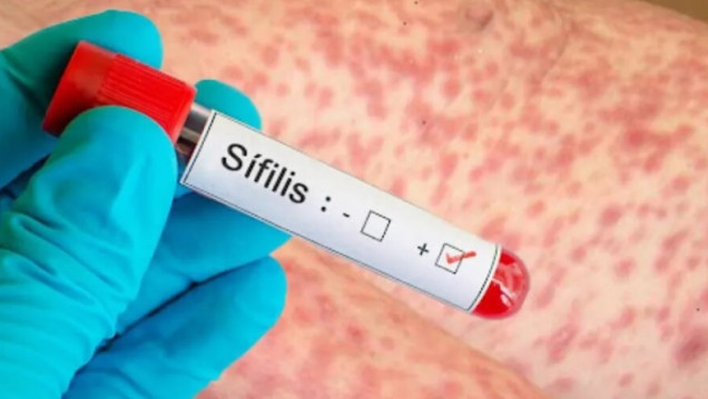 imagen Alerta por el exponencial aumento de casos de sífilis en Argentina