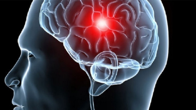 imagen Calidad de vida: factores de riesgo para el accidente cerebrovascular