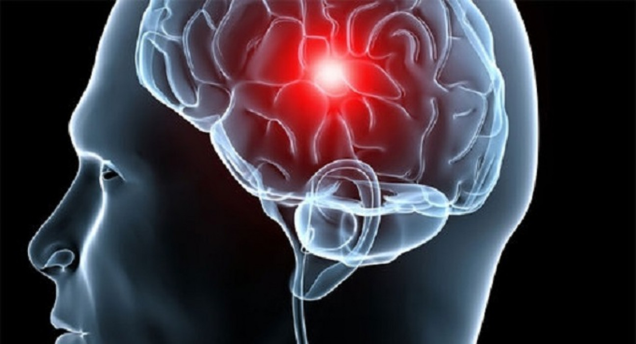 imagen Calidad de vida: factores de riesgo para el accidente cerebrovascular
