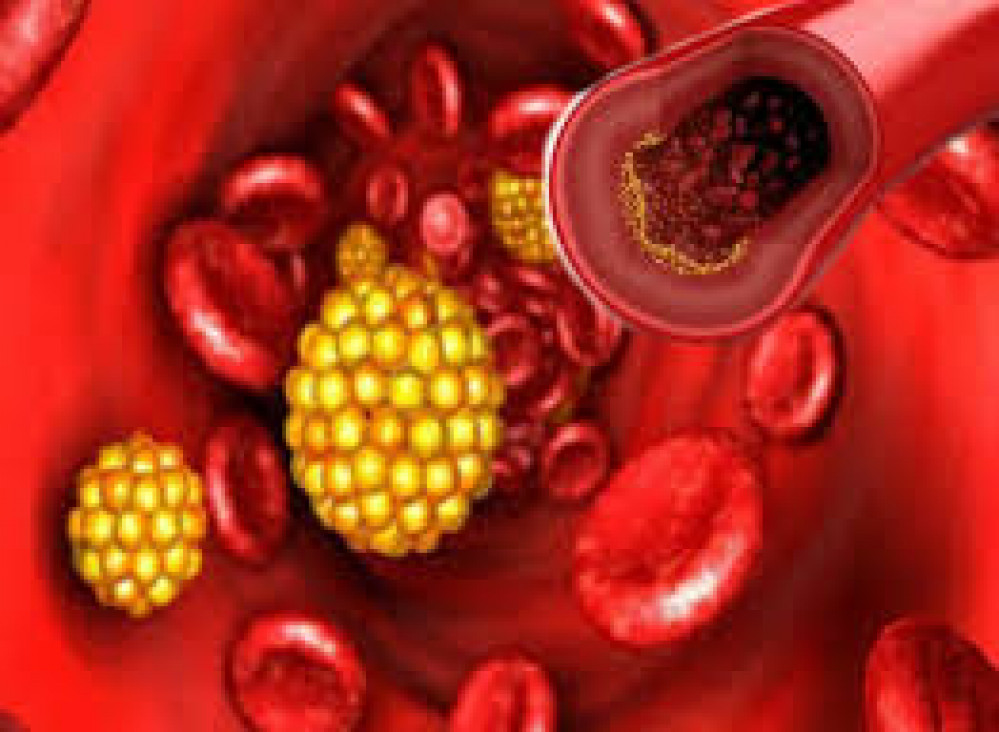 imagen Factores de riesgo: triglicéridos y colesterol alto