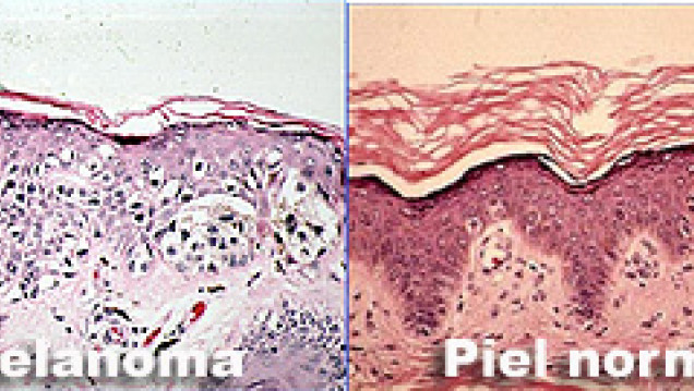 imagen Melanoma: un tipo de cáncer aún sin medicina eficaz.
