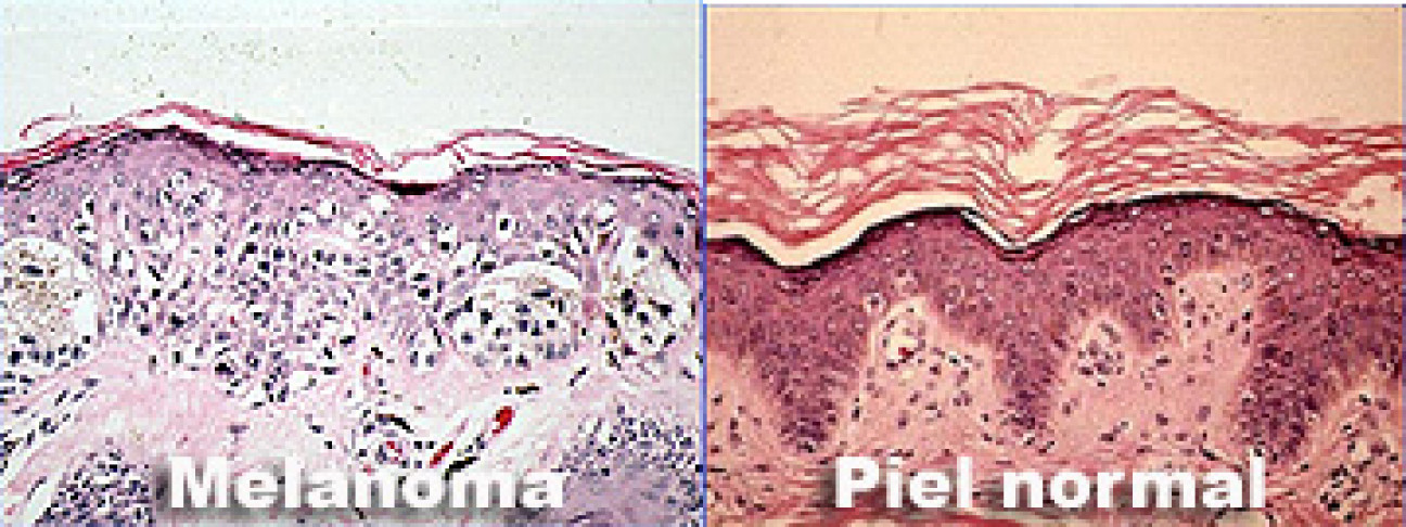 imagen Melanoma: un tipo de cáncer aún sin medicina eficaz.