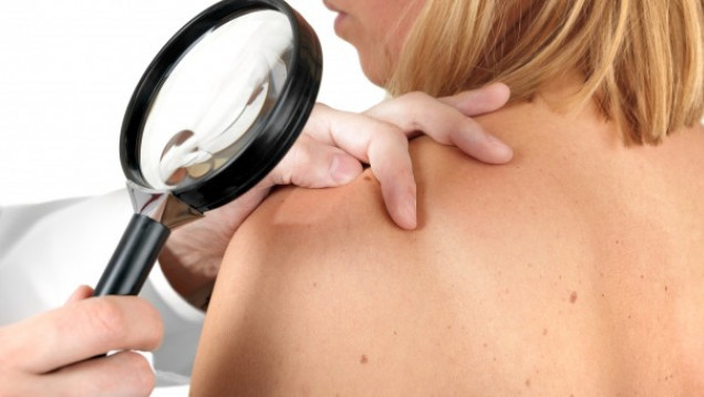 imagen El Hospital Central realizará una campaña de detección de cáncer de piel