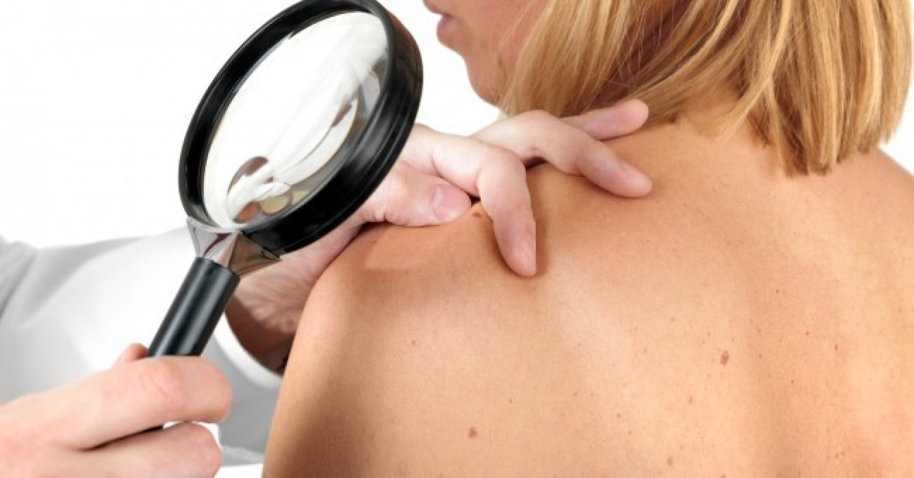 imagen El Hospital Central realizará una campaña de detección de cáncer de piel