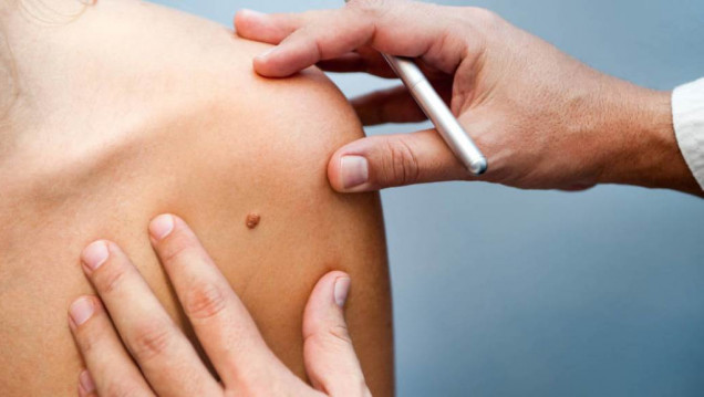 imagen Melanoma: "Se previene evitando la exposición prolongada al sol"
