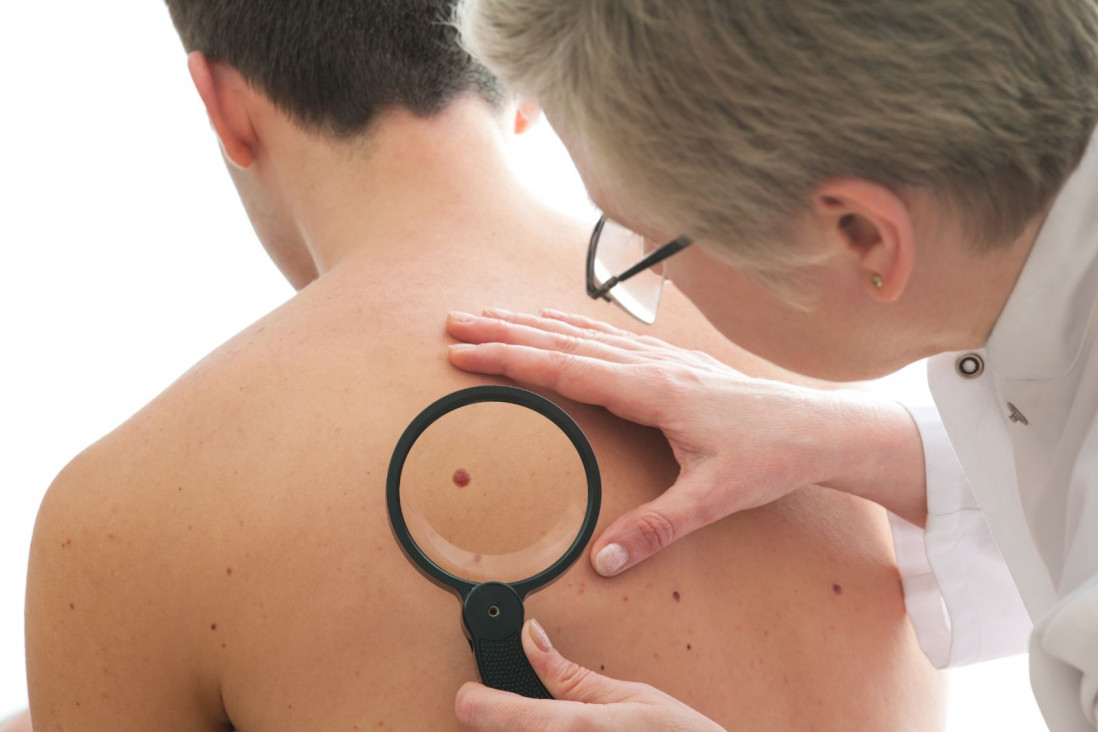 imagen Campaña de prevención de cáncer de piel