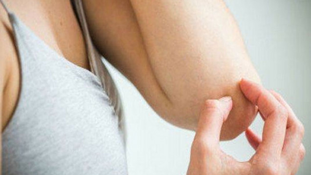 imagen Día Mundial de la Psoriasis: una enfermedad del sistema inmune