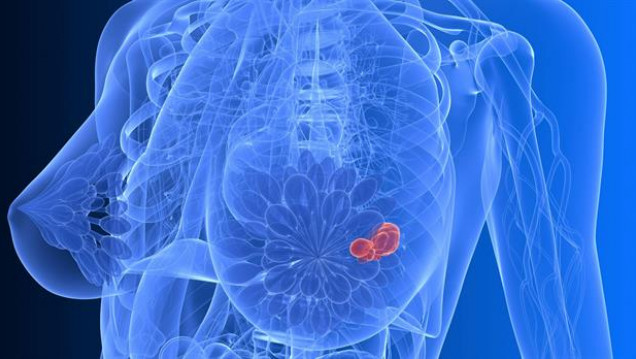 imagen Aprueban un medicamento que prolonga la vida de las personas con cáncer de mama