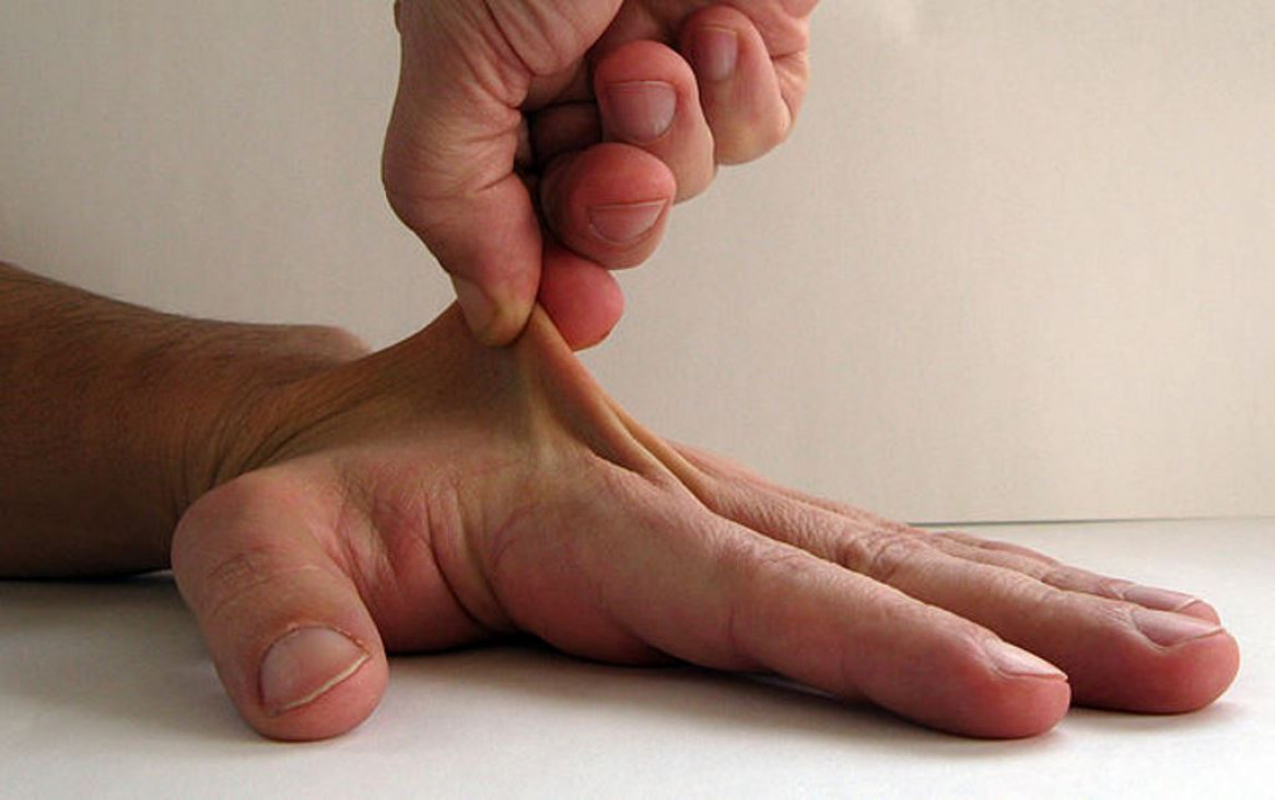 imagen Una rara enfermedad, mal diagnosticada 