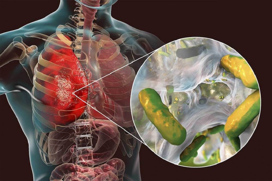 imagen Conicet: encuentran la clave de la resistencia a antibióticos en un paciente con fibrosis quística