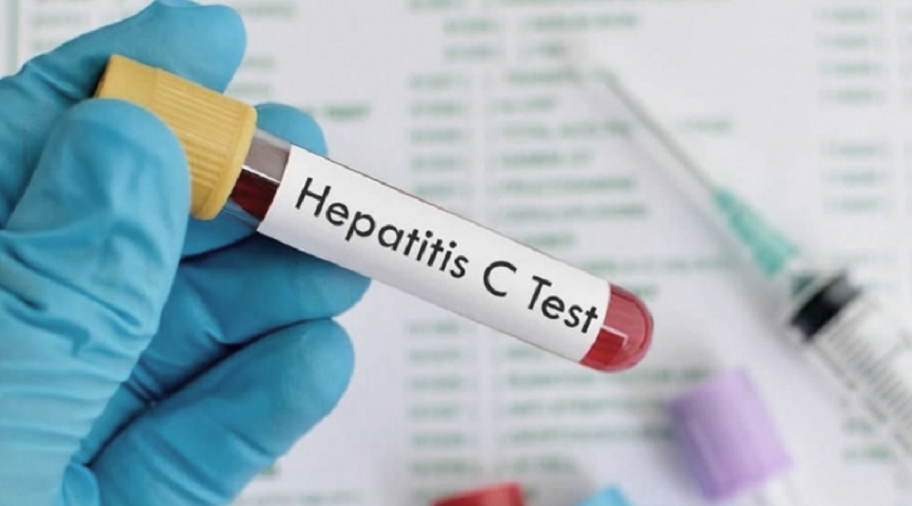 imagen Estiman que solo el 50% de las personas con hepatitis C están diagnosticadas