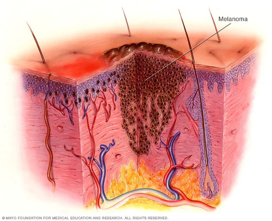 imagen Avance argentino en tratamientos antitumorales: el caso de terapias anti-angiogénicas en pacientes con melanoma