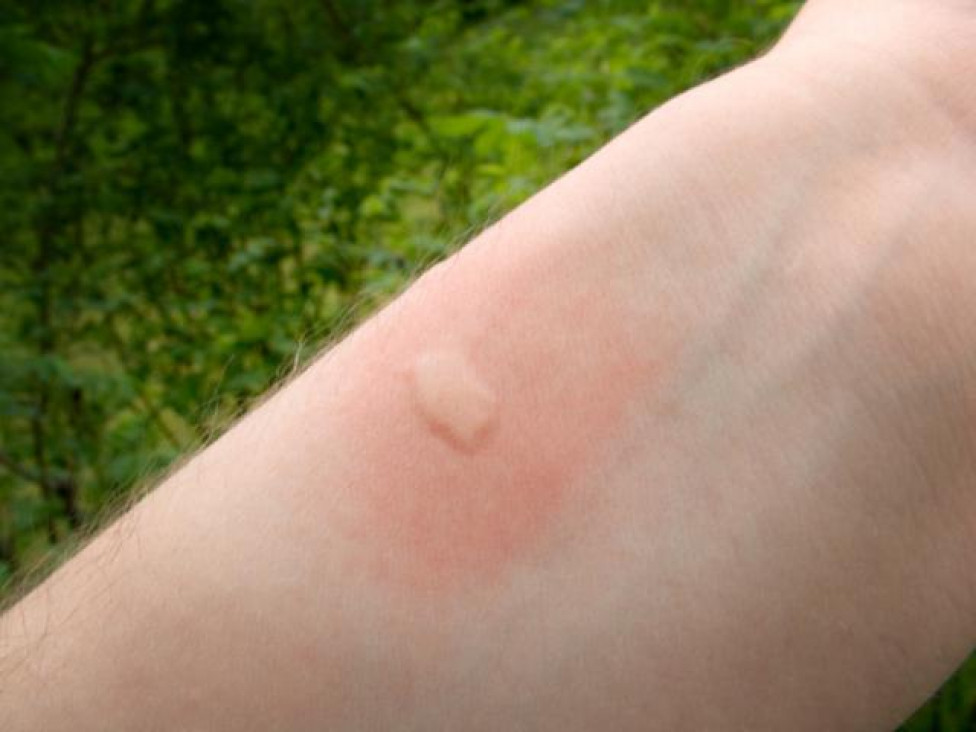 imagen El mito de la sangre dulce: los mosquitos pican por el olor a pie